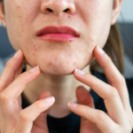 Accutane and Alcohol: What You Need to Know