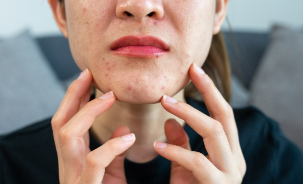 Accutane and Alcohol: What You Need to Know